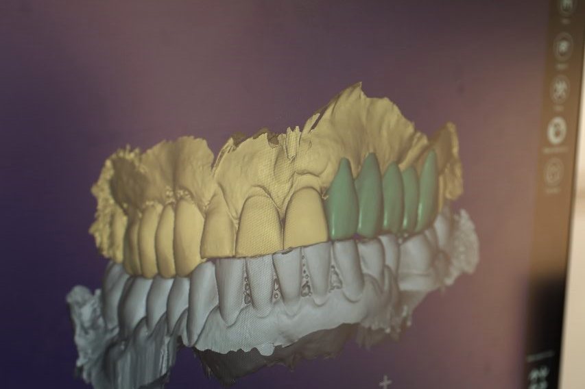 Laboratori dentar dixhital në Klinikën AlbDental