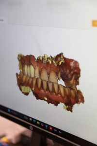 Laboratori dentar dixhital në Klinikën AlbDental