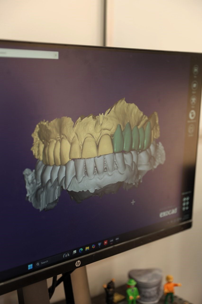 Laboratori dentar dixhital në Klinikën AlbDental